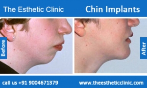 Chin-Implants-before-after-photos-mumbai-india-1
