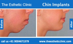 Chin-Implants-before-after-photos-mumbai-india-2
