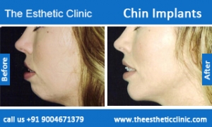 Chin-Implants-before-after-photos-mumbai-india-3