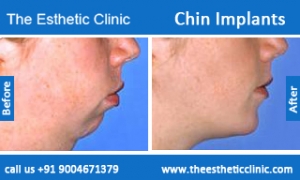 Chin-Implants-before-after-photos-mumbai-india-4