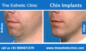 Chin-Implants-before-after-photos-mumbai-india-6