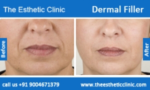 Dermal-Filler-1