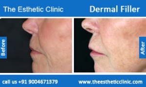 Dermal-Filler-2