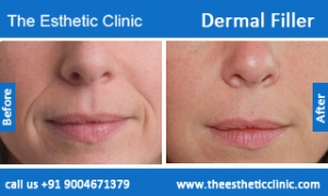 Dermal-Filler-3