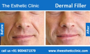 Dermal-Filler-4