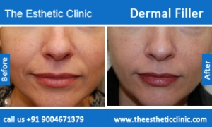Dermal-Filler-5