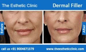 Dermal-Filler-6