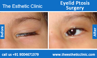 Eyelid-Ptosis-Surgery-before-after-photos-mumbai-india-2