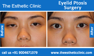 Eyelid-Ptosis-Surgery-before-after-photos-mumbai-india-3