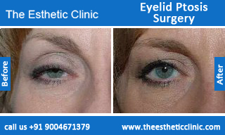 Eyelid-Ptosis-Surgery-before-after-photos-mumbai-india-5