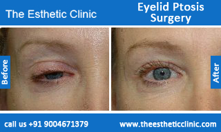 Eyelid-Ptosis-Surgery-before-after-photos-mumbai-india-6