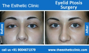 Eyelid-Ptosis-Surgery-before-after-photos-mumbai-india-1
