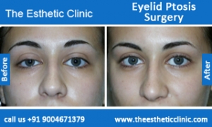 Eyelid-Ptosis-Surgery-before-after-photos-mumbai-india-1 Eyelid-Ptosis-Surgery-before-after-photos-mumbai-india-1