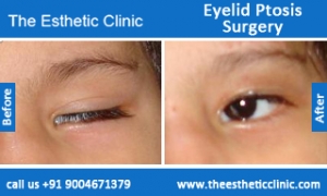Eyelid-Ptosis-Surgery-before-after-photos-mumbai-india-2 Eyelid-Ptosis-Surgery-before-after-photos-mumbai-india-2