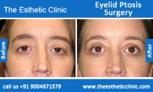 Eyelid-Ptosis-Surgery-before-after-photos-mumbai-india-4 Eyelid-Ptosis-Surgery-before-after-photos-mumbai-india-4