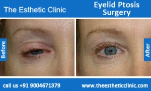 Eyelid-Ptosis-Surgery-before-after-photos-mumbai-india-6 Eyelid-Ptosis-Surgery-before-after-photos-mumbai-india-6