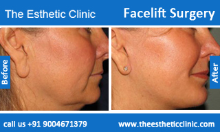facelift-surgery-before-after-photos-mumbai-india-1