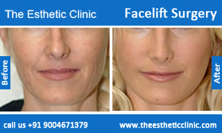 facelift-surgery-before-after-photos-mumbai-india-3