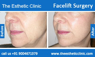 facelift-surgery-before-after-photos-mumbai-india-4