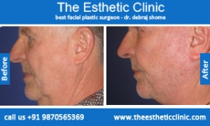 facelift-surgery-before-after-photos-mumbai-india-2