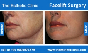 facelift-surgery-before-after-photos-mumbai-india-5