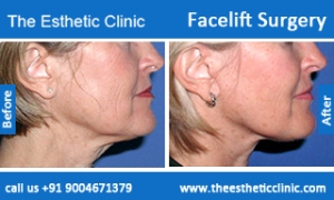 facelift-surgery-before-after-photos-mumbai-india-6
