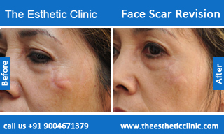face-scar-revision-before-after-photos-mumbai-india-3
