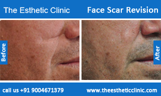 face-scar-revision-before-after-photos-mumbai-india-5