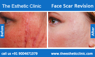face-scar-revision-before-after-photos-mumbai-india-6