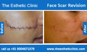 face-scar-revision-before-after-photos-mumbai-india-2