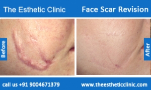 face-scar-revision-before-after-photos-mumbai-india-4