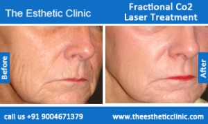 Fractional-Co2-Laser-treatment-before-after-photos-mumbai-india-1 (1)