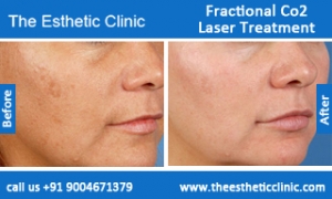 Fractional-Co2-Laser-treatment-before-after-photos-mumbai-india-1 (5)