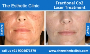 Fractional-Co2-Laser-treatment-before-after-photos-mumbai-india-1 (6)