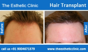 hair-transplant-before-after-photos-mumbai-india-1