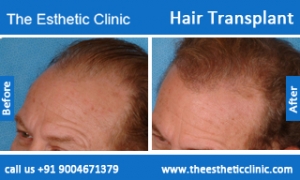hair-transplant-before-after-photos-mumbai-india-2
