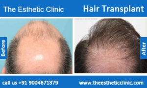 hair-transplant-before-after-photos-mumbai-india-4