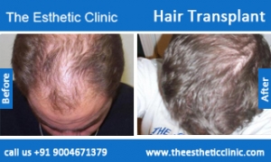 hair-transplant-before-after-photos-mumbai-india-5