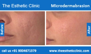 microdermabrasion-treatment-before-after-photos-mumbai-india-1 (3)