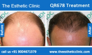 QR678-Treatment-1