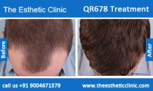 QR678-Treatment-2