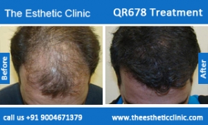 QR678-Treatment-5