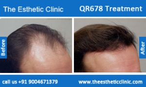 QR678-Treatment-6