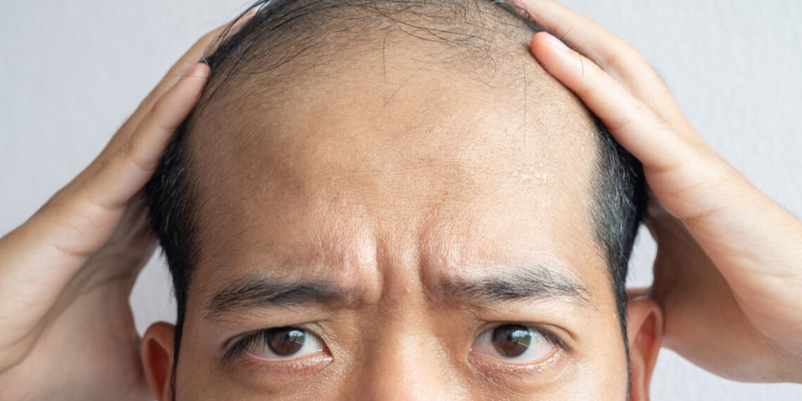 Hair Loss Treatment Mumbai, India (QR678)