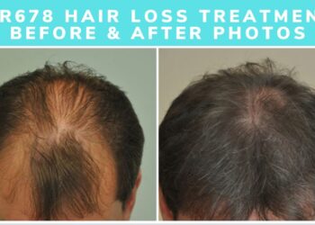 QR 678 - Best Hair Growth, Prevent Hair Loss Treatment FAQ’s.