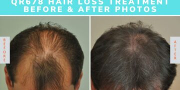 QR 678 - Best Hair Growth, Prevent Hair Loss Treatment FAQ’s.