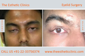 Ptosis Eyelid Surgery in India