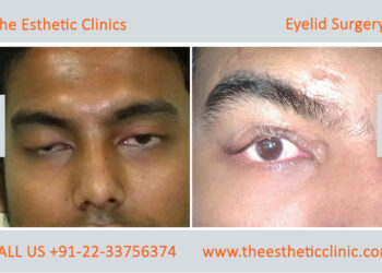 Ptosis Eyelid Surgery in India