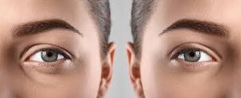 Blepharoplasty Surgery in Mumbai– Eyelid Sagging & Bags Removal Surgery