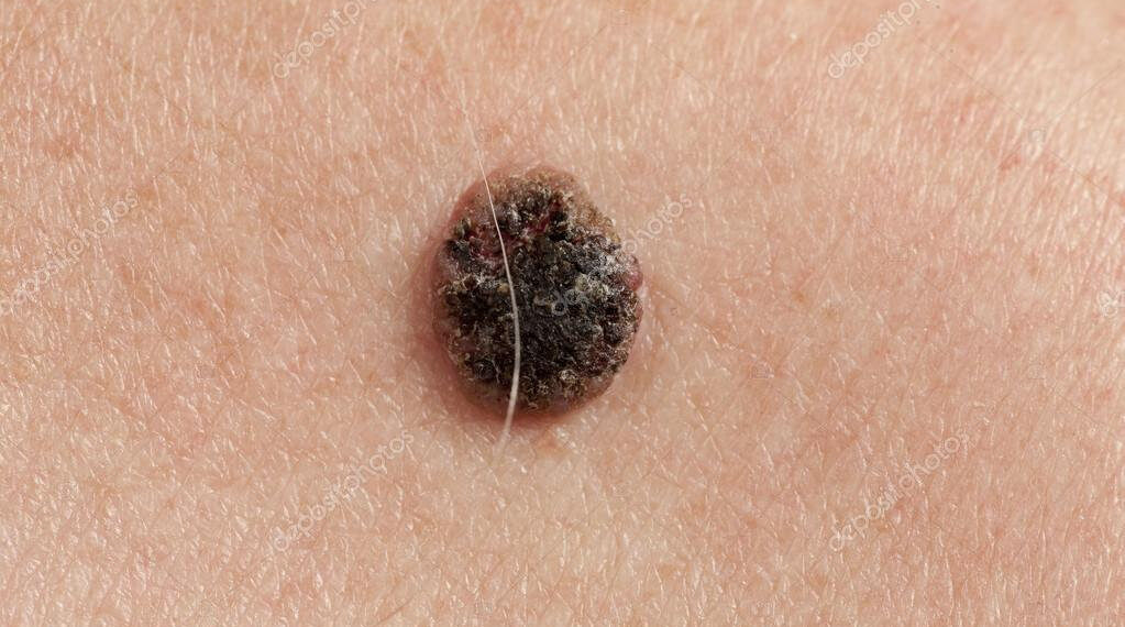 Squamous cell carcinoma treatment